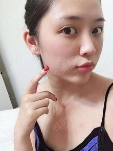 吃瓜肿嘴唇,揭秘肿嘴唇的成因与护理攻略